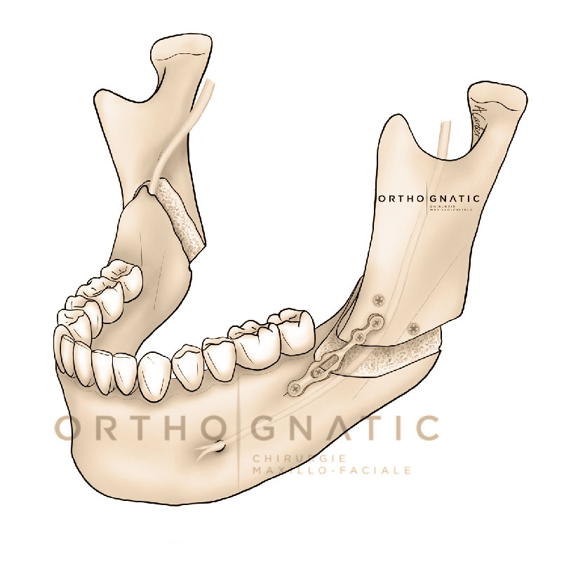 Osteotomie angle mandibule