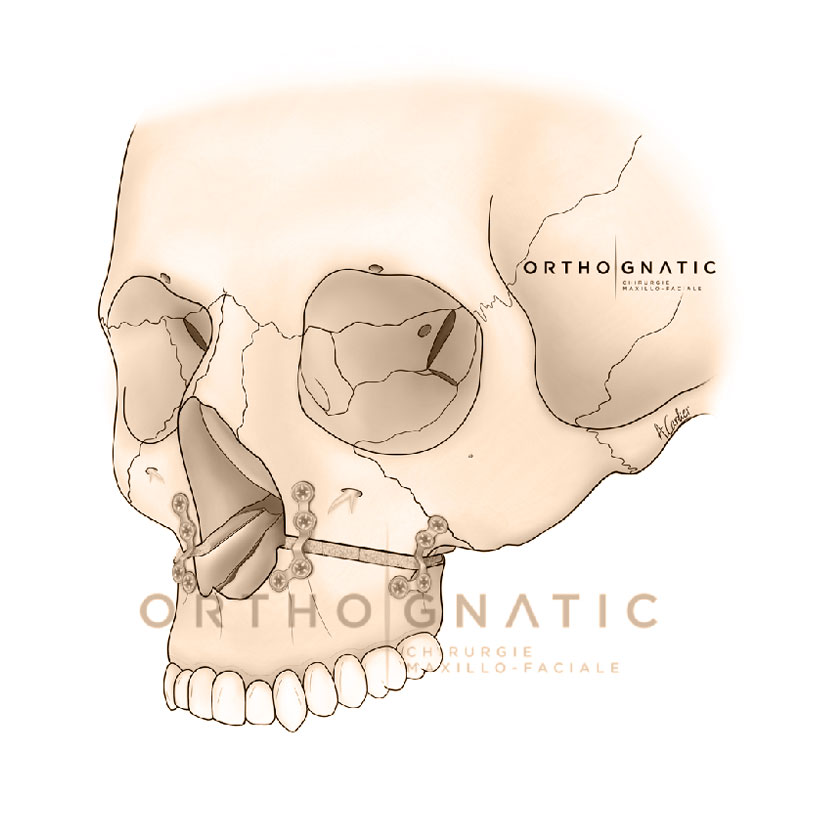 Osteotomie maxillaire