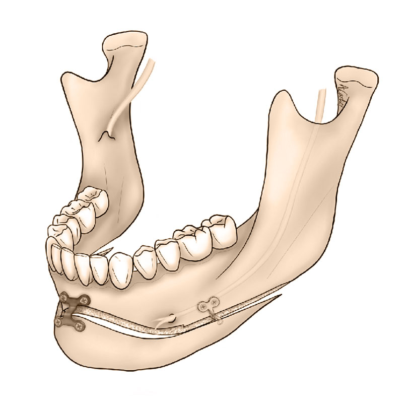 Ostéotomie du menton